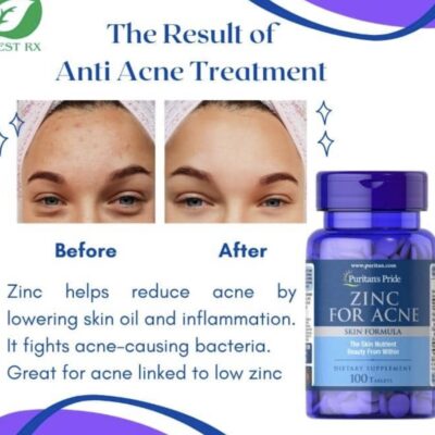 Zinc for acne