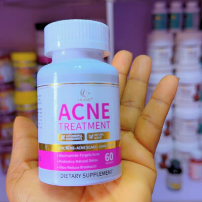 Douzi acne treatment